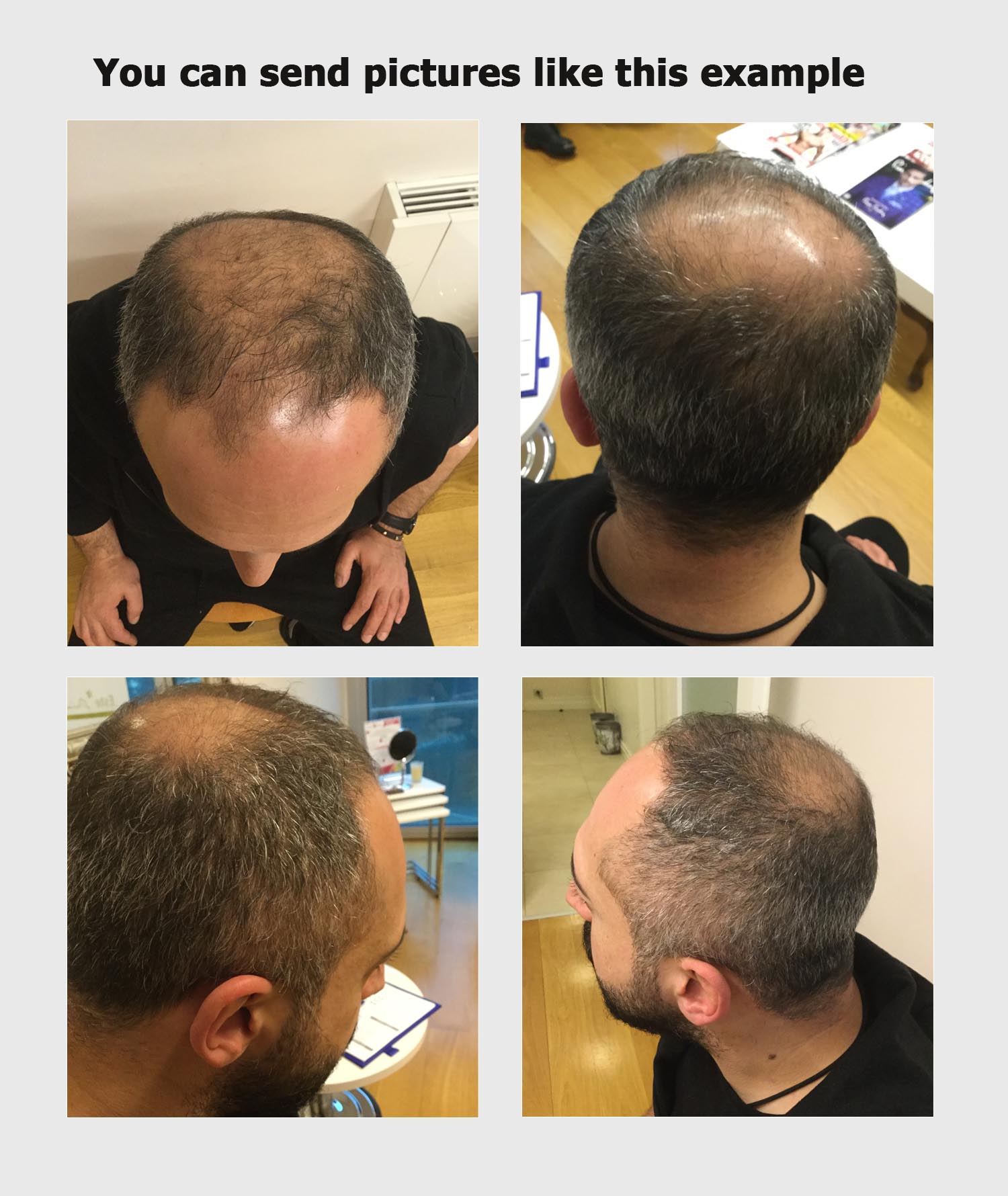 Hair transplant photo tips and guidelines