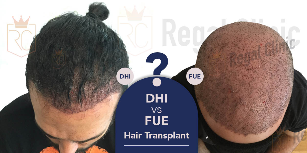 DHI vs FUE Hair Transplant - Regal Clinic